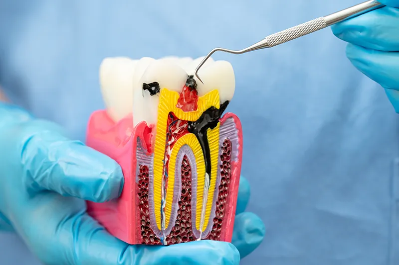 endodontie-wurzelbehandlung-1
